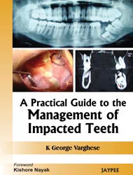 A Practical Guide to the Management of Impacted Teeth