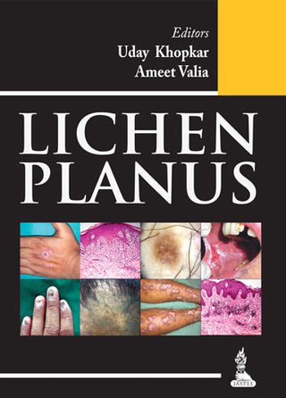 Lichen planus