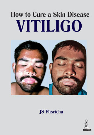 How to Cure a Skin Disease Vitiligo