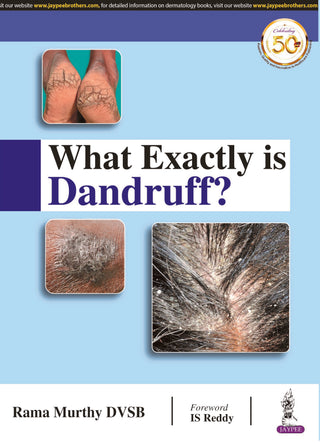 What Exactly is Dandruff?