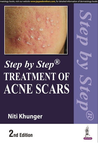 Step by Step Treatment of Acne Scars