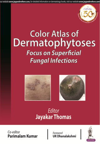 Color Atlas of Dermatophytoses: Focus on Superficial Fungal Infections